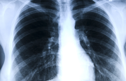 ВОЗ обеспокоена распространением лекарственно-устойчивого туберкулеза в России